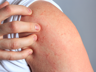 Managing Allergy Hives Effectively